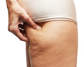 Woman-cellulite-copy
